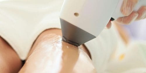 IPL voor welke lichaamsdelen